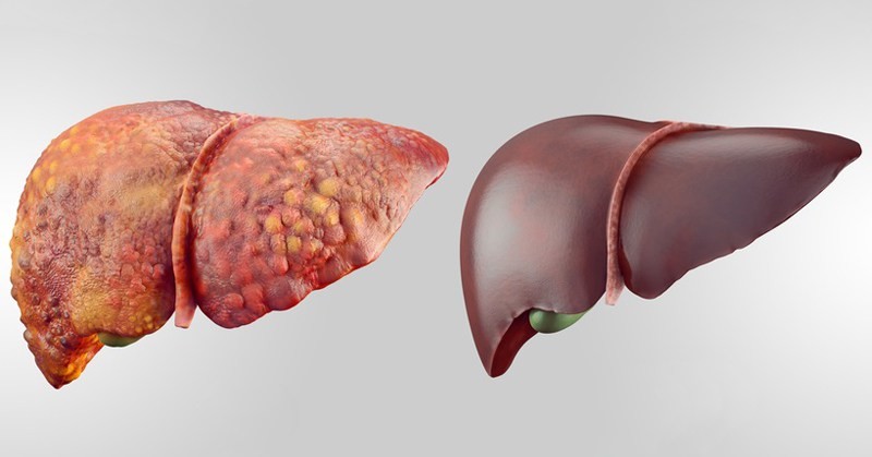 من هم الأكثر عرضة للإصابة بتشمع الكبد؟ 
