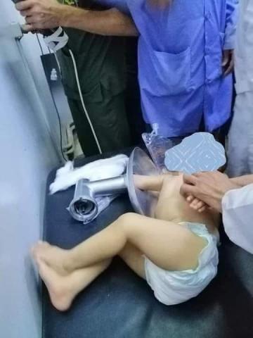  طفلة بجروح جراء ادخال يدها بماكينة اللحمة وهي تعمل.