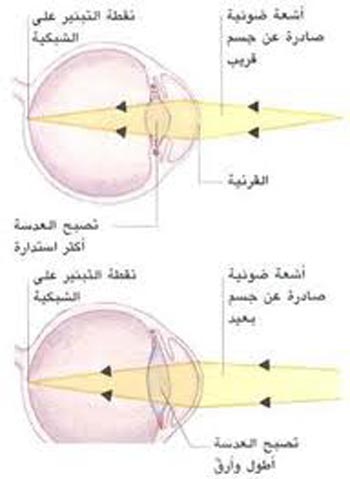 يمكن أيضا معالجة قصر النظر بحقن جينات سليمة في العين.